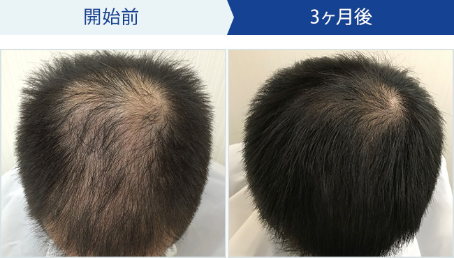 BIDANの発毛治療｜30代男性の発毛効果
