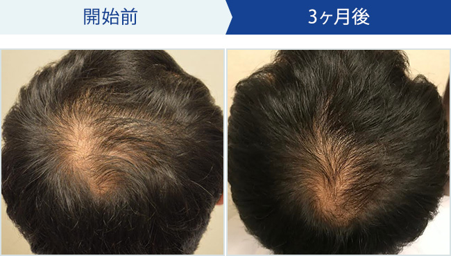 BIDANの発毛治療｜40代男性の発毛効果