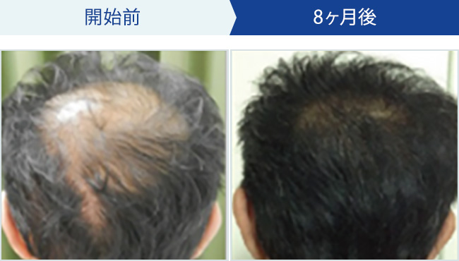 BIDANの発毛治療｜50代男性の発毛効果