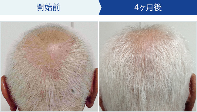 BIDANの発毛治療｜50代男性の発毛効果